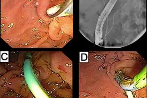 ERCP