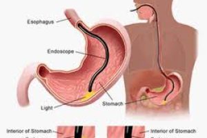 Endoscopy