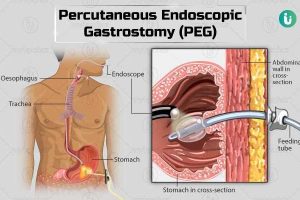 PEG TUBE INSERTION