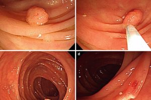 Polypectomy