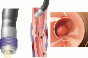 Variceal banding