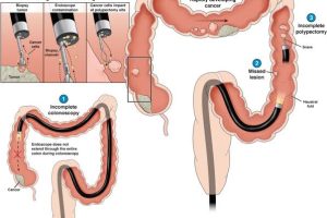 colonoscopy