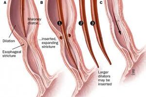 esophageal dilatation